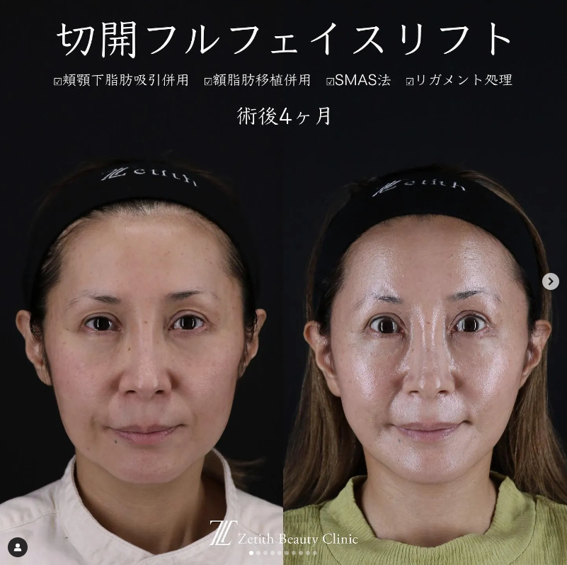 王医師による切開フェイスリフト＋頬アゴ下脂肪吸引＋額こめかみ脂肪注入の施術前／施術後4ヶ月