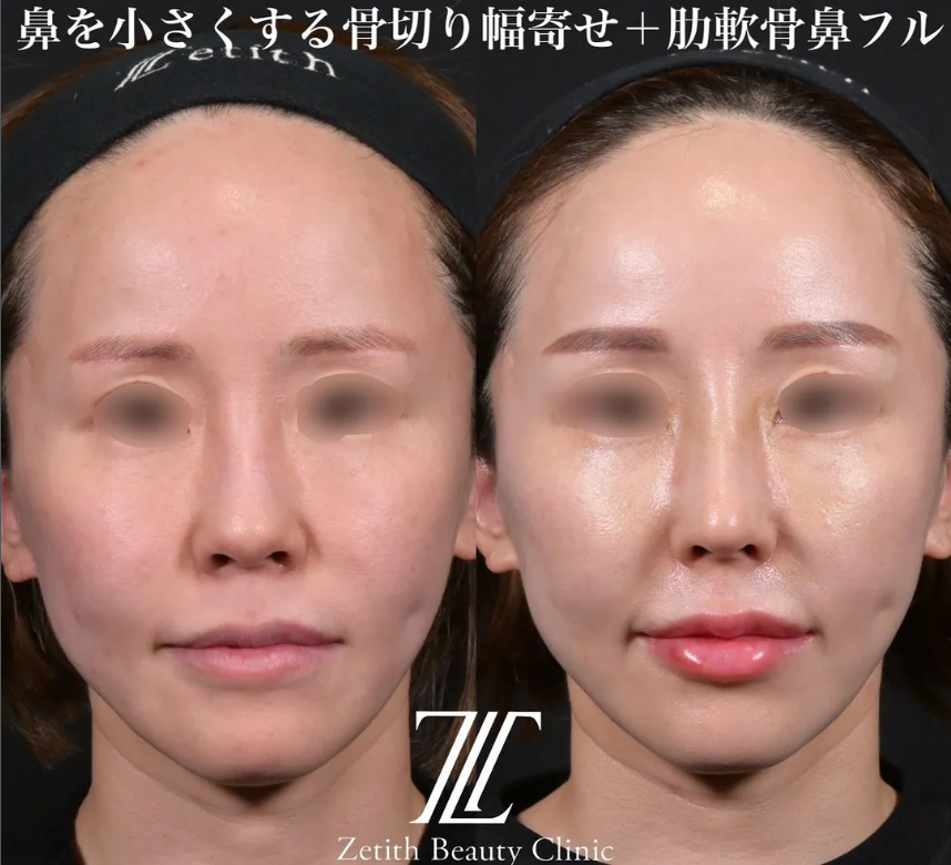 鉄医師による鼻のフルコースの施術前／施術後2週間
