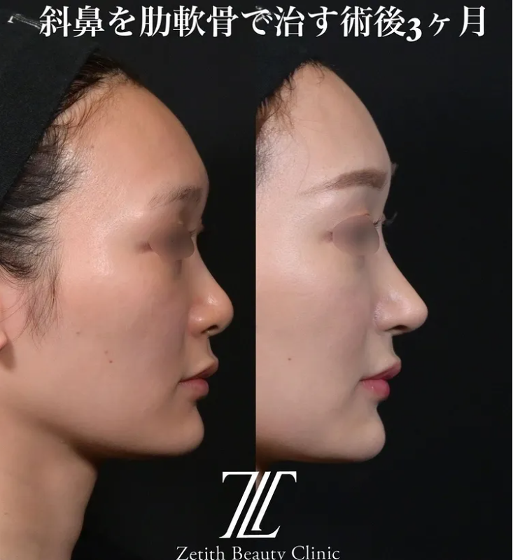 鉄医師による鼻のフルコースの施術前／施術後3ヶ月