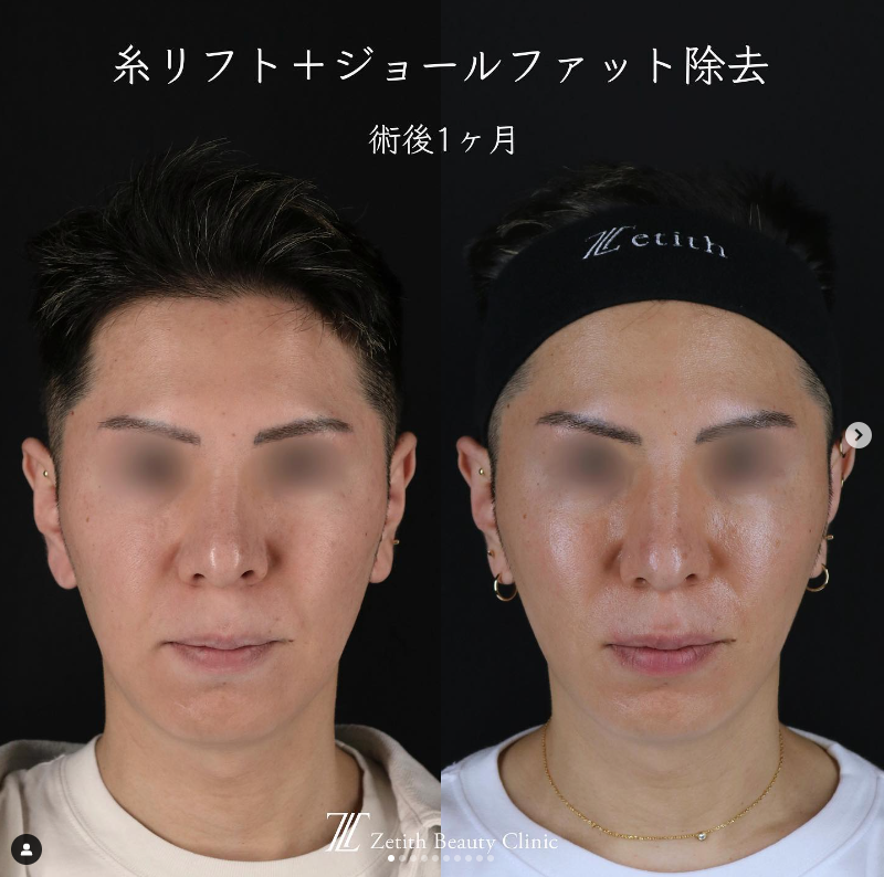王医師による糸リフト＋ジョールファット除去の施術前／施術後1ヶ月