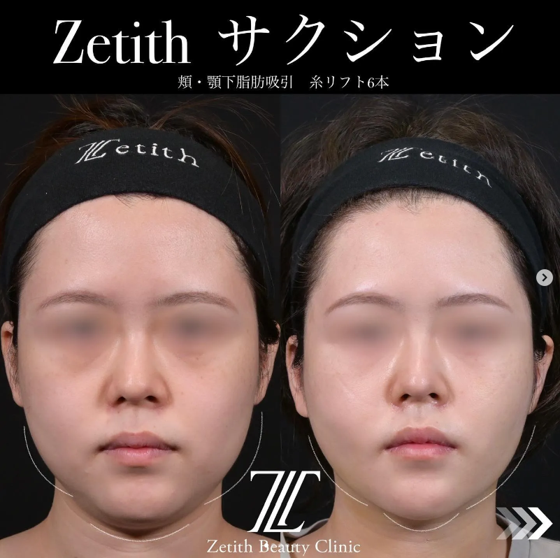 北村医師による脂肪吸引＋糸リフトの施術前／施術後1週間
