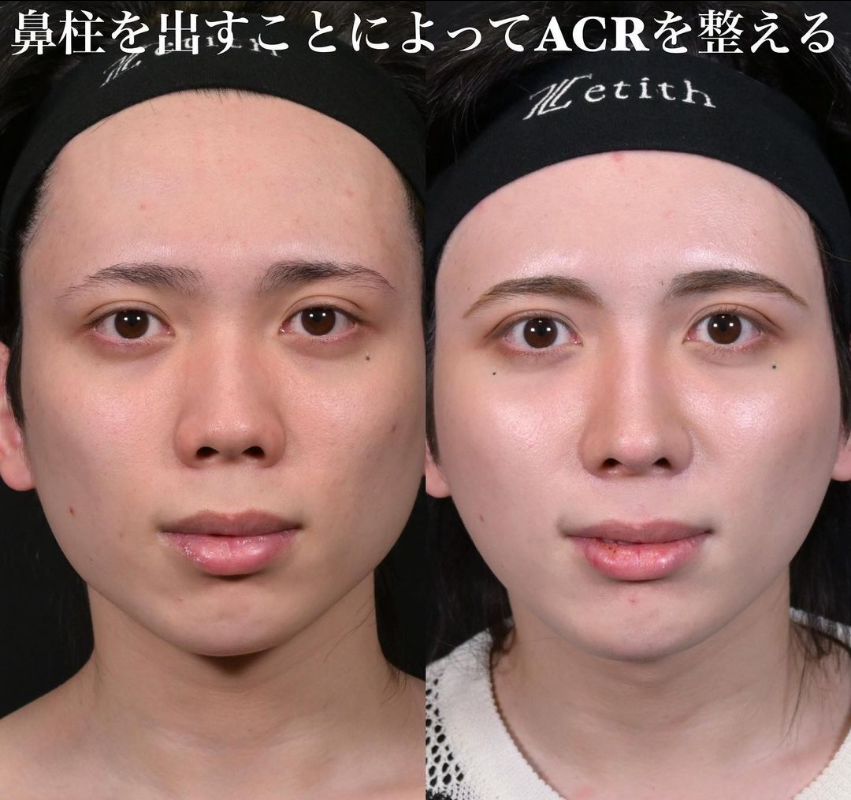 鉄医師による鼻のフルコースの施術前／施術後3ヶ月