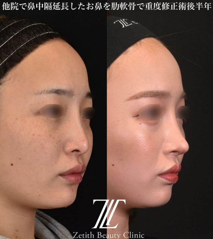 鉄医師による鼻のフルコースの施術前／施術後6ヶ月 术后 