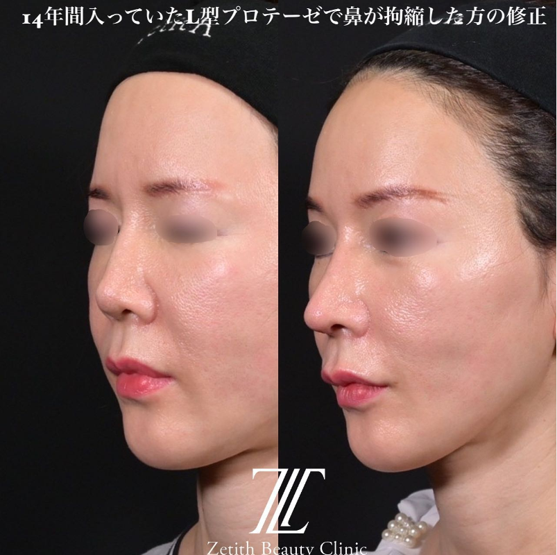 鉄医師による鼻のフルコースの施術前／施術後1ヶ月