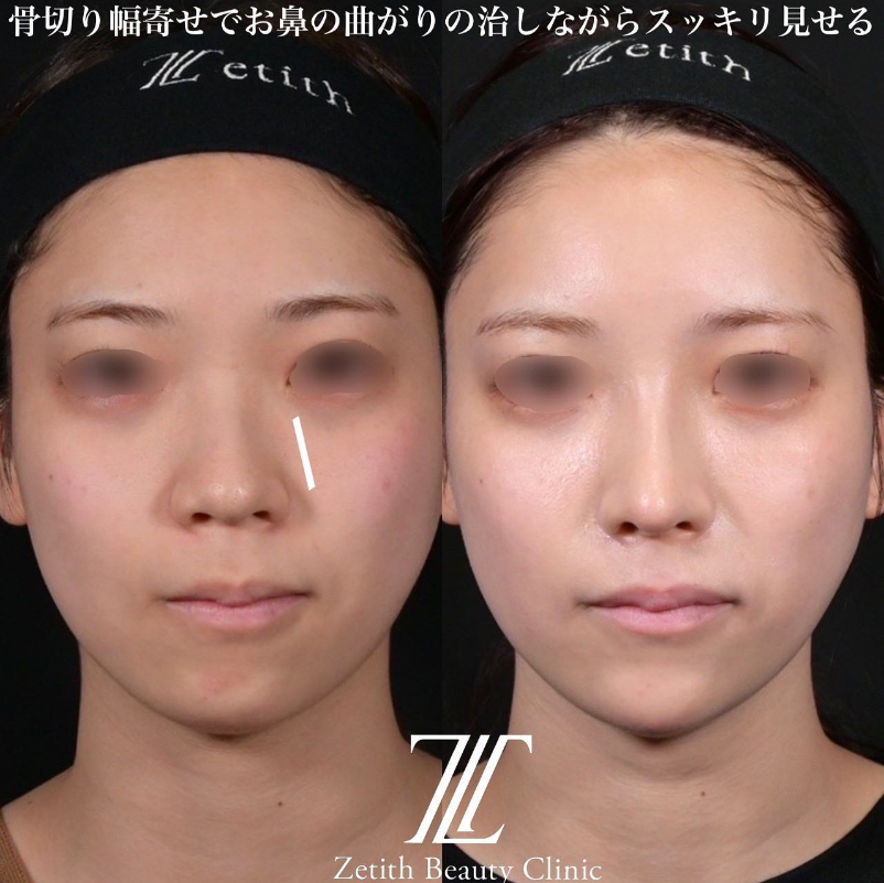 鉄医師による鼻のフルコースの施術前／施術後1ヶ月 Дараа 