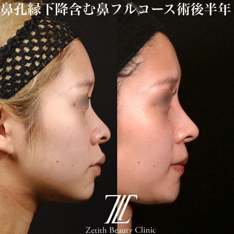 鉄医師による鼻のフルコースの施術前／施術後6ヶ月 施術後 