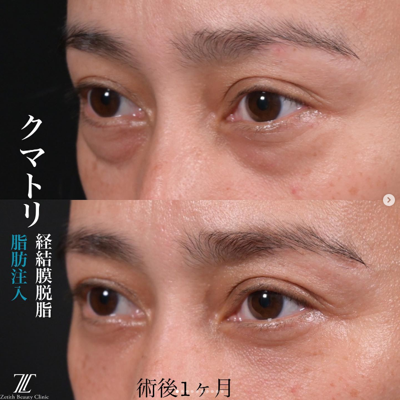 上木原医師によるクマ取り＋脂肪注入の施術前／施術後1ヶ月 施術後 