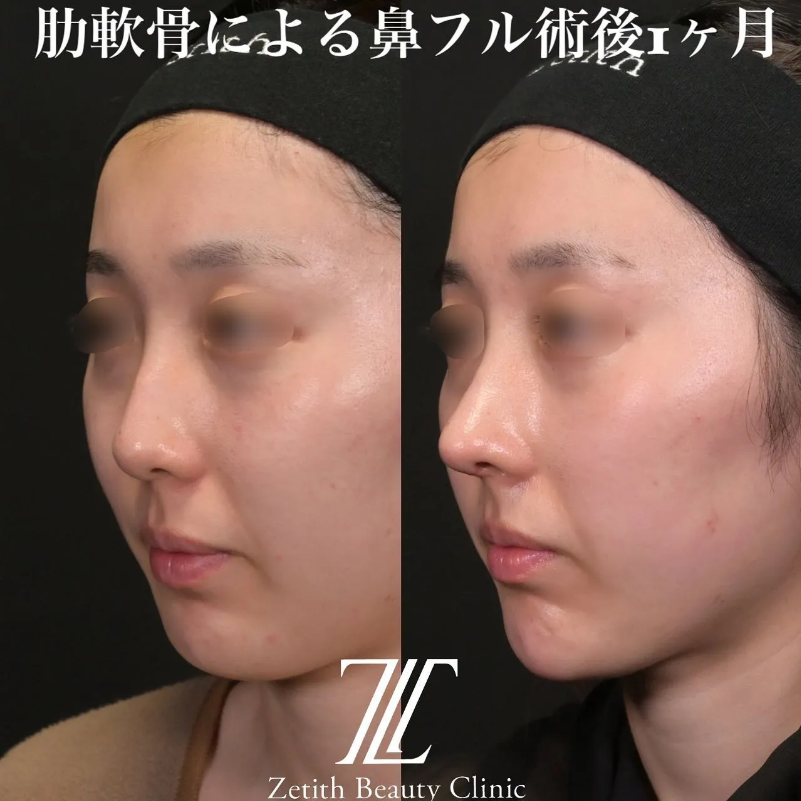 鉄医師による鼻のフルコースの施術前／施術後1ヶ月
