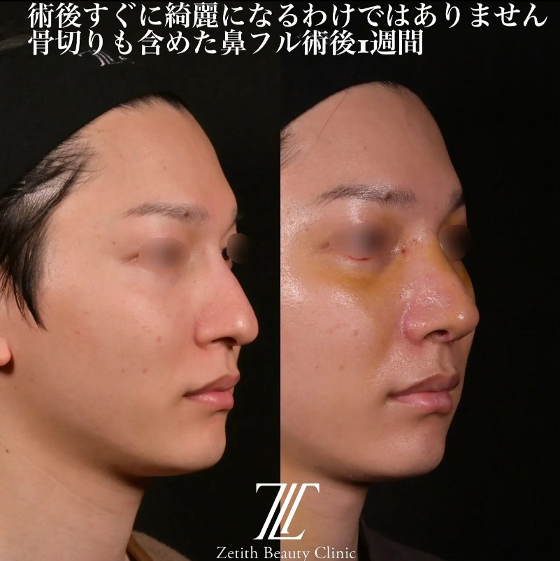 鉄医師による鼻のフルコースの施術前／施術後1週間 施術後 