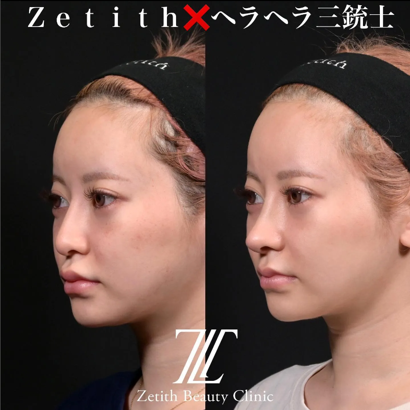 鉄医師による鼻のフルコースの施術前／施術後1ヶ月 施術後 