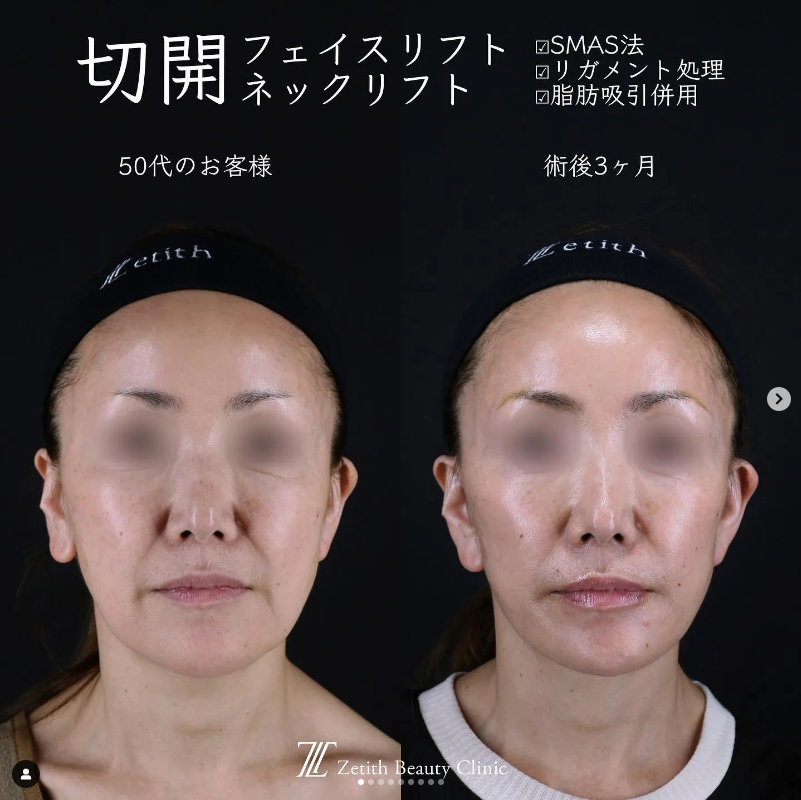 王医師による切開フェイスリフト＋頬アゴ下脂肪吸引の施術前／施術後3ヶ月