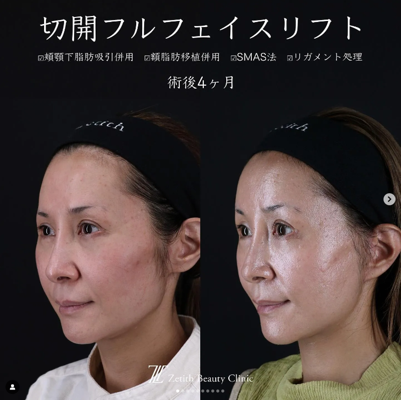 王医師による切開フェイスリフト＋頬アゴ下脂肪吸引＋額こめかみ脂肪注入の施術前／施術後4ヶ月 术后 