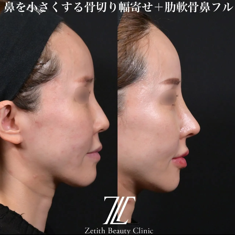 鉄医師による鼻のフルコースの施術前／施術後2週間 Дараа 