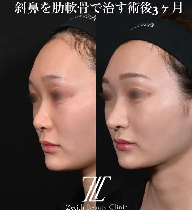 鉄医師による鼻のフルコースの施術前／施術後3ヶ月 Дараа 