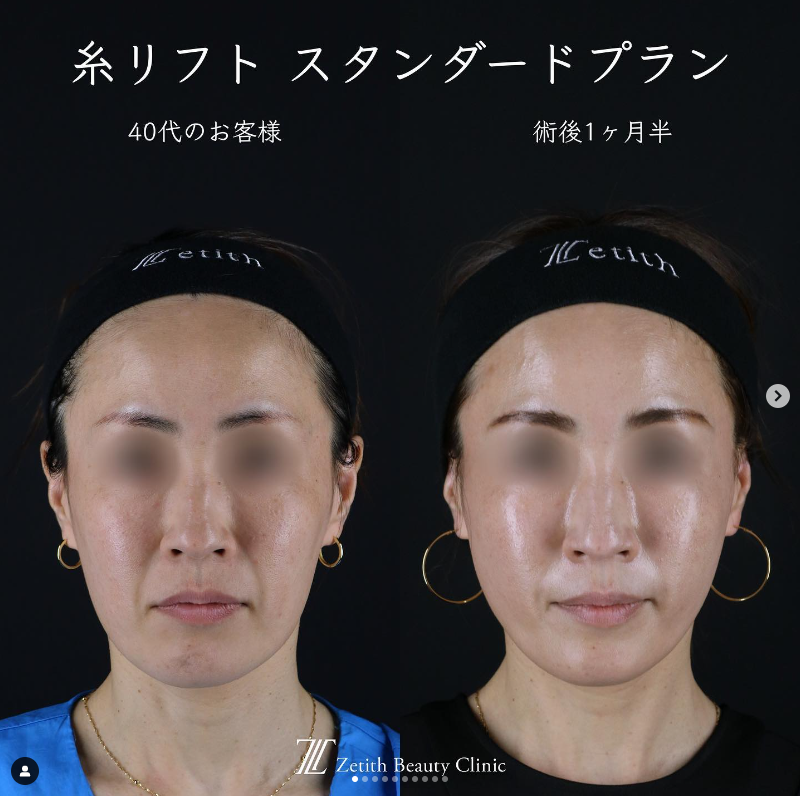 王医師による糸リフトの施術前／施術後1ヶ月半