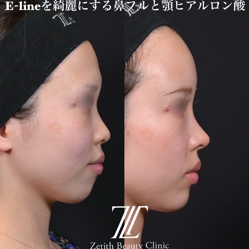 鉄医師による鼻のフルコースの施術前／施術後3ヶ月