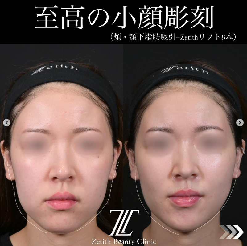 北村医師による脂肪吸引＋糸リフトの施術前／施術後1ヶ月