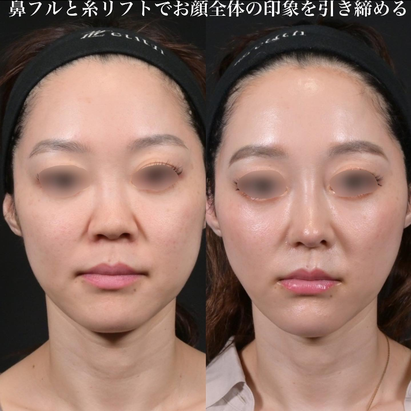 鉄医師による鼻のフルコースの施術前／施術後1ヶ月
