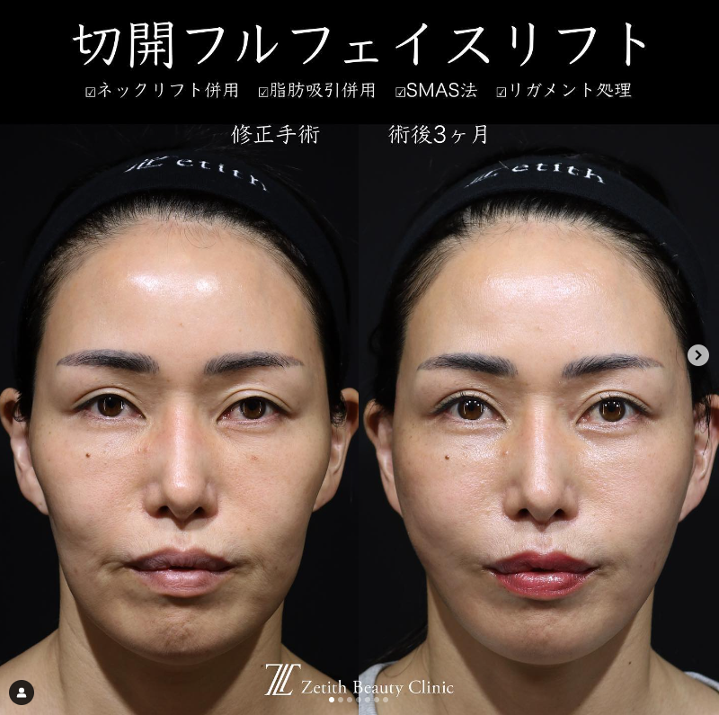 王医師による切開フェイスリフトの施術前／施術後3ヶ月