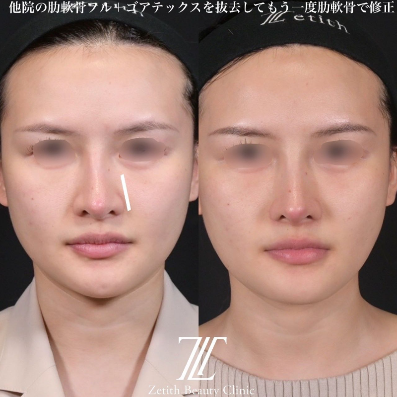 鉄医師による鼻のフルコースの施術前／施術後1ヶ月