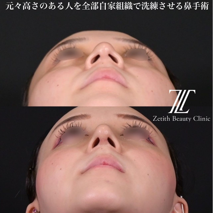 鉄医師による鼻のフルコースの施術前／施術後2週間 施術後 