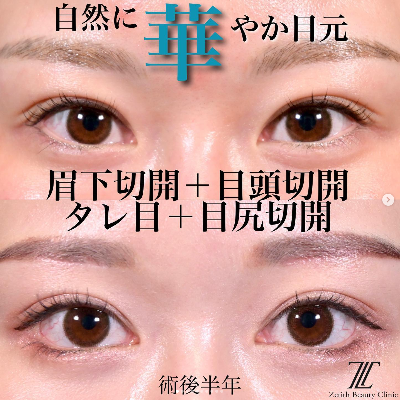 上木原医師による眉下切開＋目頭切開＋目尻切開＋タレ目形成の施術前／施術後6ヶ月
