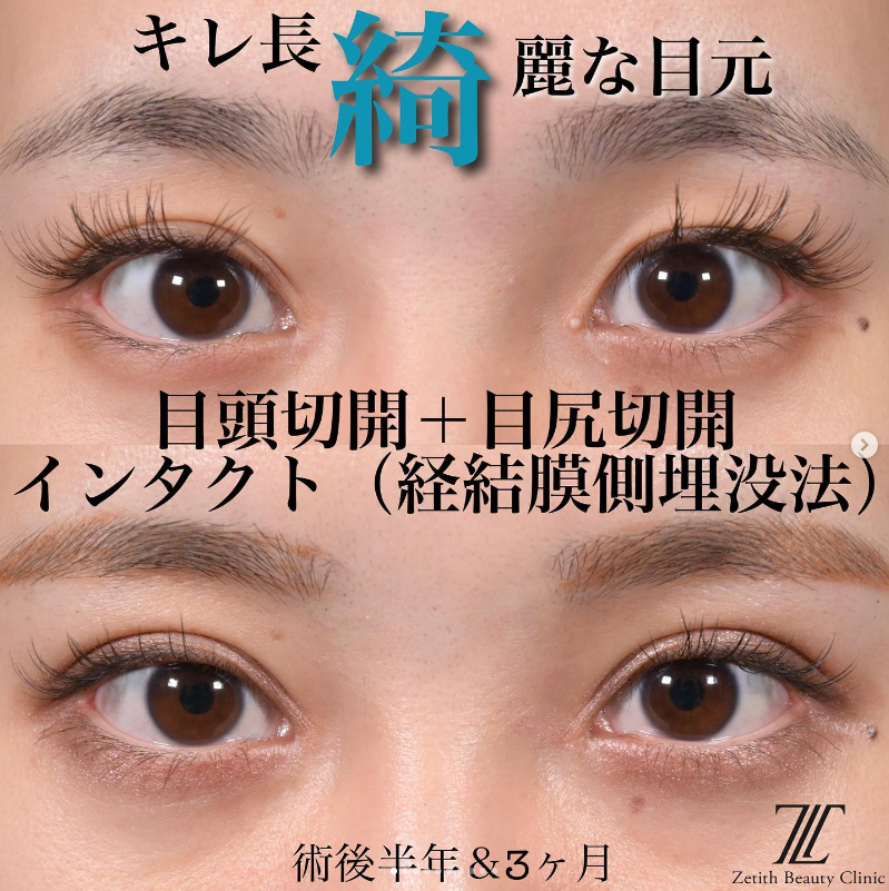 目頭切開＋目尻切開＋二重埋没法の施術前／施術後6ヶ月