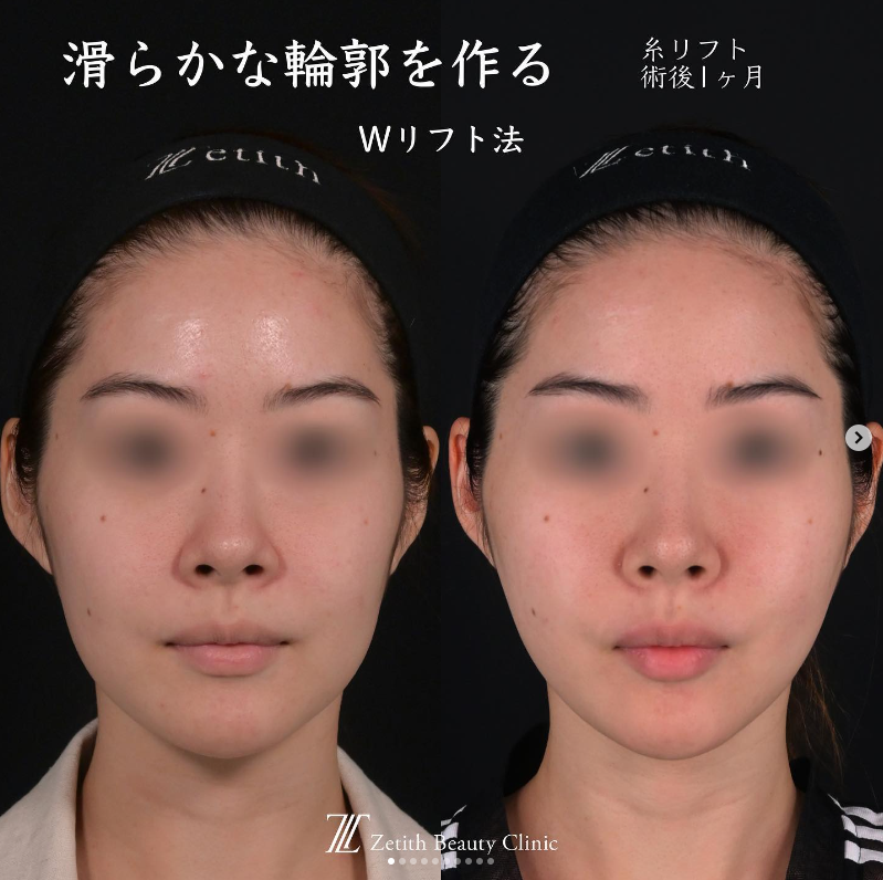 王医師による糸リフトの施術前／施術後1ヶ月