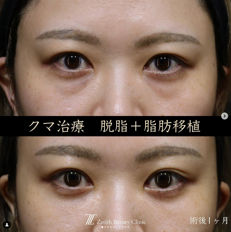 王医師によるクマ取り＋脂肪注入の施術前／施術後1ヶ月