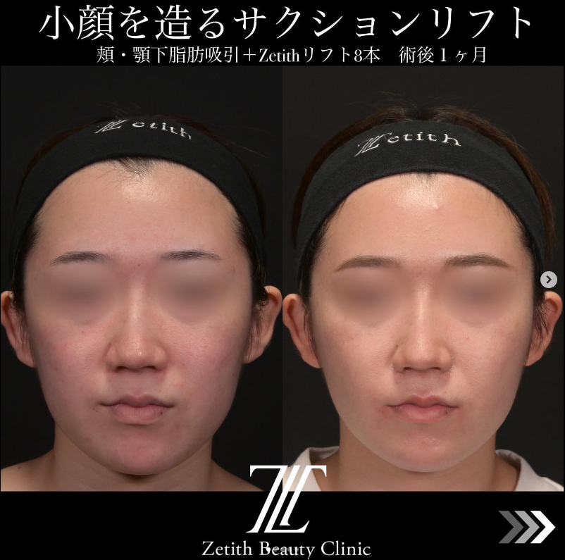 北村医師による脂肪吸引＋糸リフトの施術前／施術後1ヶ月