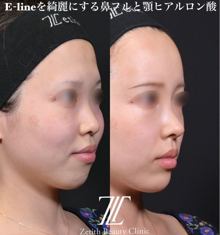 鉄医師による鼻のフルコースの施術前／施術後3ヶ月 施術後 
