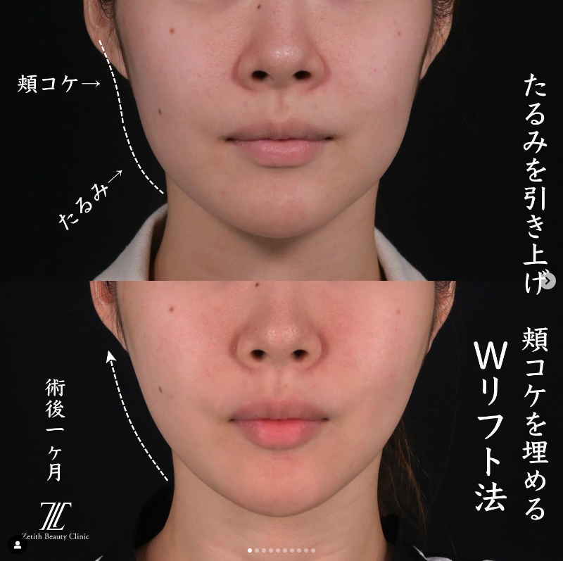 王医師による糸リフトの施術前／施術後1ヶ月 术后 
