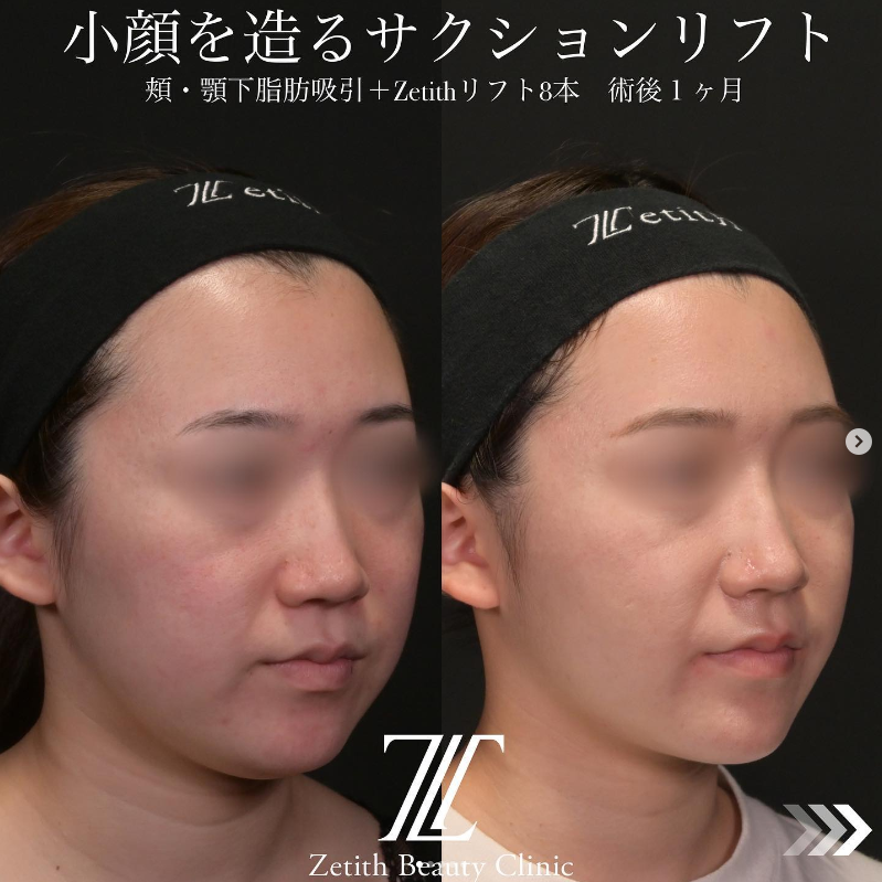 北村医師による脂肪吸引＋糸リフトの施術前／施術後1ヶ月 施術後 
