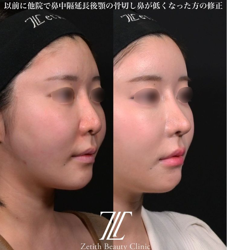 鉄医師による鼻のフルコースの施術前／施術後3ヶ月 术后 