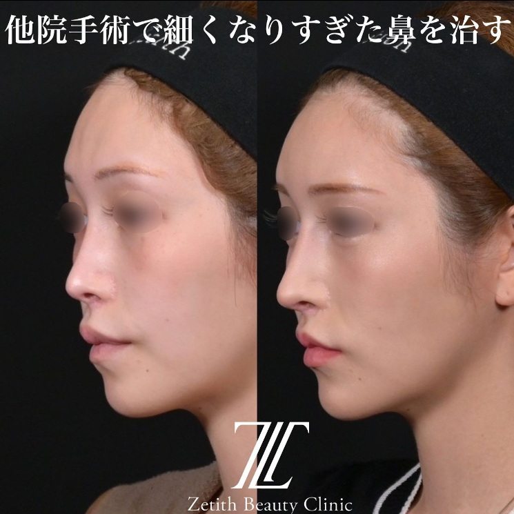 鉄医師による鼻のフルコースの施術前／施術後3ヶ月