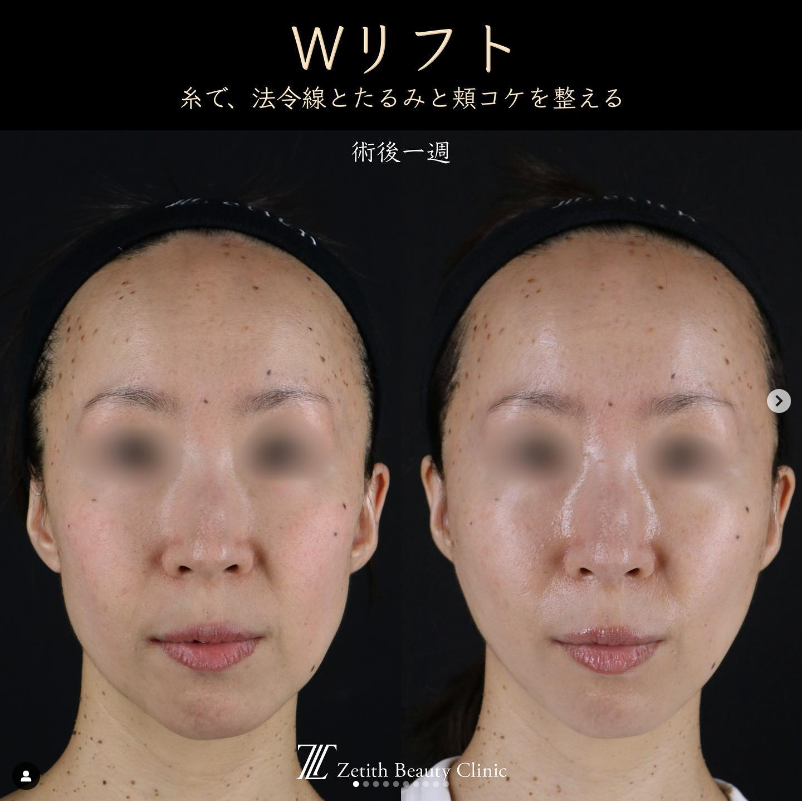 王医師による糸リフトの施術前／施術後1週間