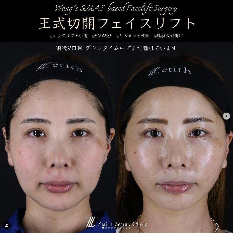 王医師による切開フェイスリフト＋脂肪吸引（頬＋顎下）の施術前／施術後9日目