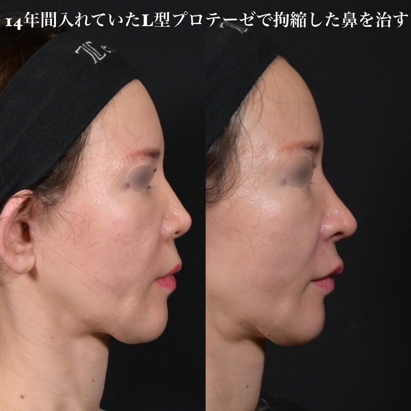 鉄医師による鼻のフルコースの施術前／施術後3ヶ月