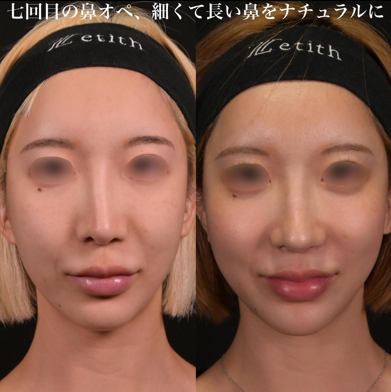 鉄医師による鼻のフルコースの施術前／施術後3ヶ月