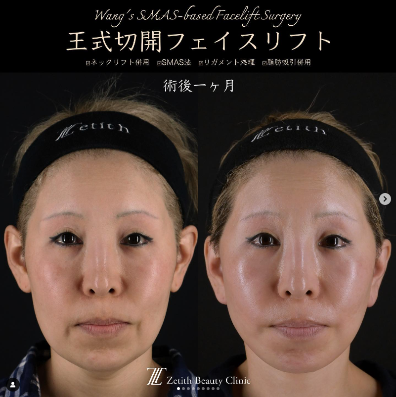 王医師による切開フェイスリフトの施術前／施術後1ヶ月