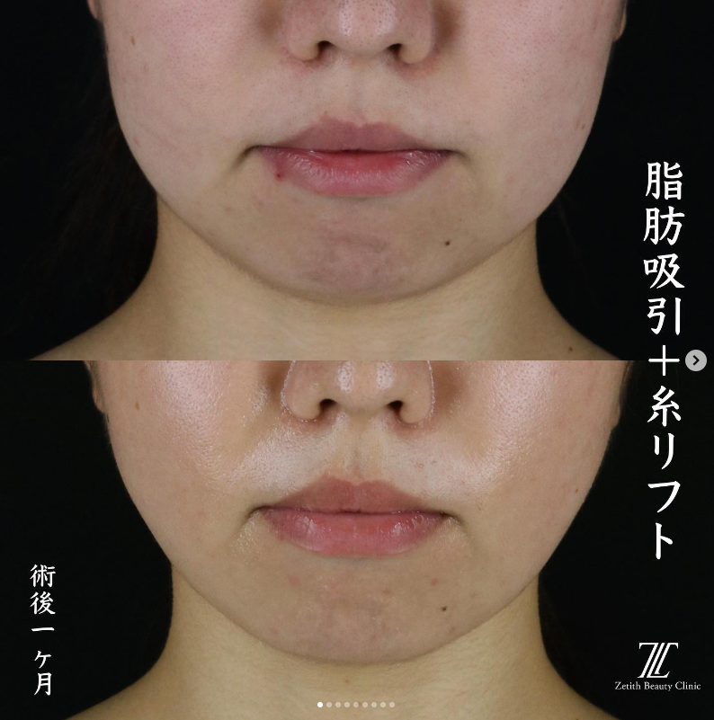 王医師による脂肪吸引＋糸リフトの施術前／施術後1ヶ月 施術後 