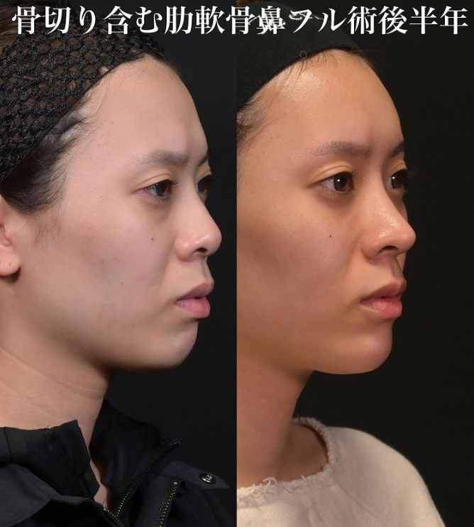 鉄医師による鼻のフルコースの施術前／施術後6ヶ月 施術後 