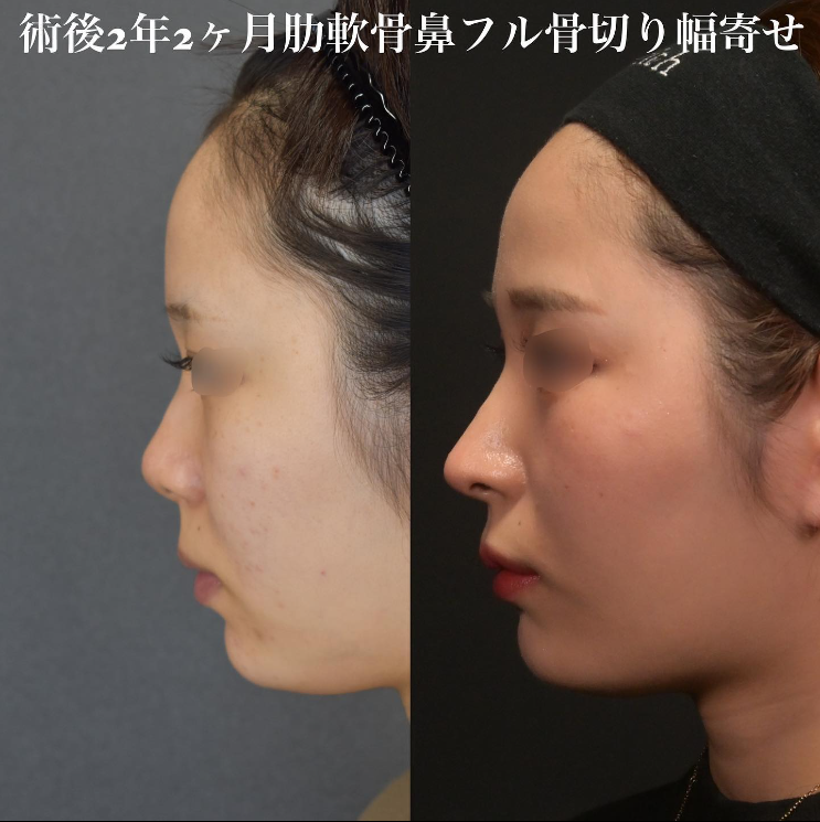 鉄医師による鼻のフルコースの施術前／施術後2年2ヶ月