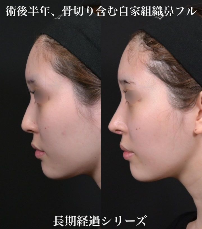 鉄医師による鼻のフルコースの施術前／施術後6ヶ月