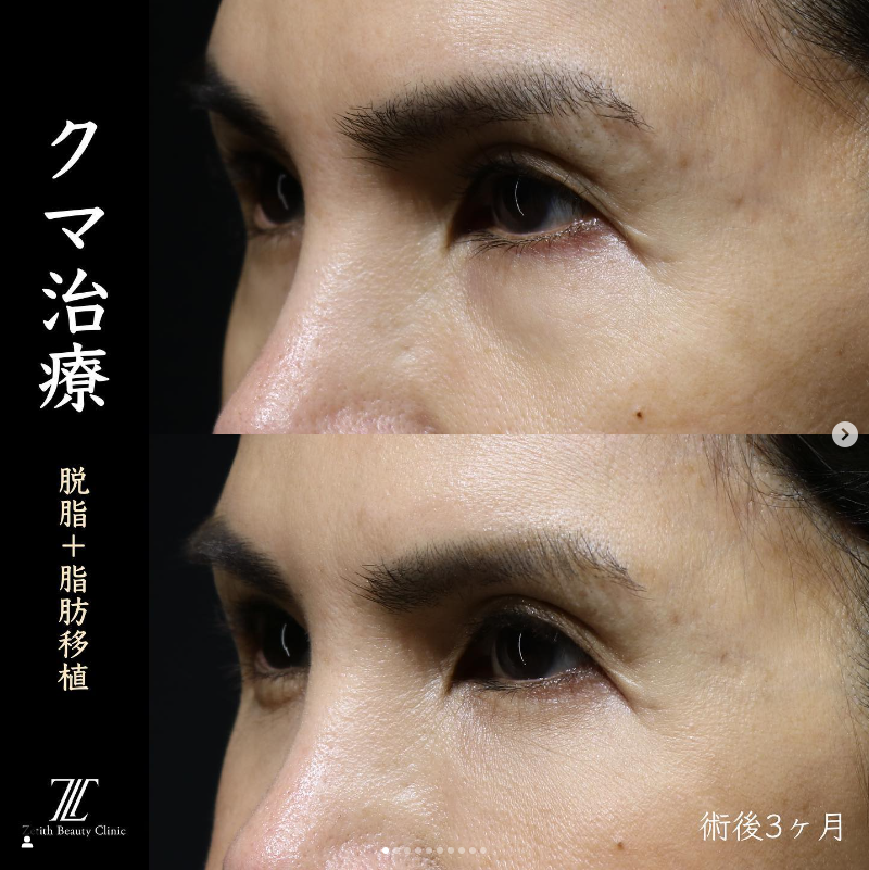 王医師によるクマ取り＋脂肪注入の施術前／施術3ヶ月