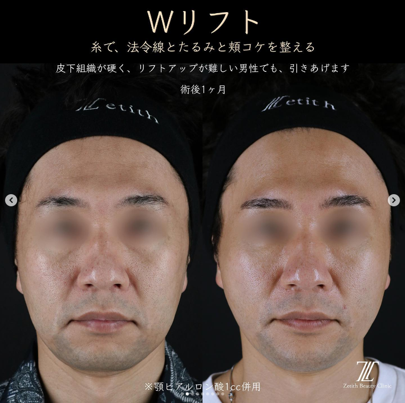 王医師による糸リフトの施術前／施術1ヶ月