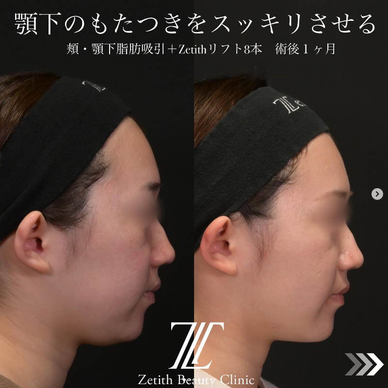 北村医師による脂肪吸引＋糸リフトの施術前／施術後1ヶ月