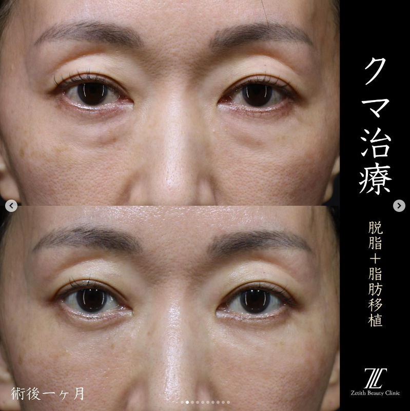 王医師によるクマ取り＋脂肪注入の施術前／施術後1ヶ月