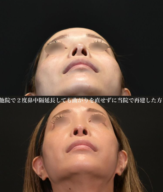 鉄医師による鼻のフルコースの施術前／施術後3ヶ月