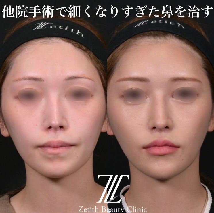 鉄医師による鼻のフルコースの施術前／施術後3ヶ月 Sau 